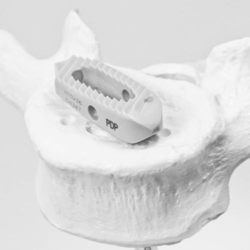 Thorako-lumbales Zwischenwirbelimplantat - P.D.P - NEURO FRANCE Implants - dorsaler Zugang / transforaminaler Zugang / aus PEEK