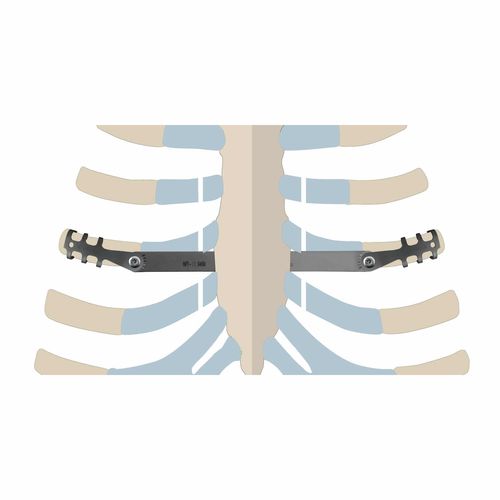 Kompressionsplatte für Rippen - ThoRib® PECTUS - NEURO FRANCE Implants - Titan / für Kinder