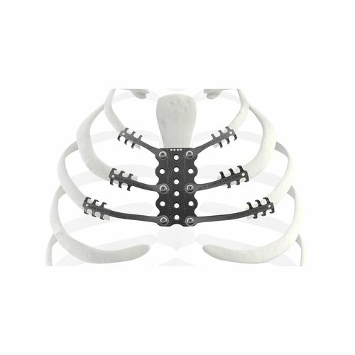 Rippenprothese zum Wiederaufbau nach Knochensarkom-Resektion - TRIONYX® - NEURO FRANCE Implants