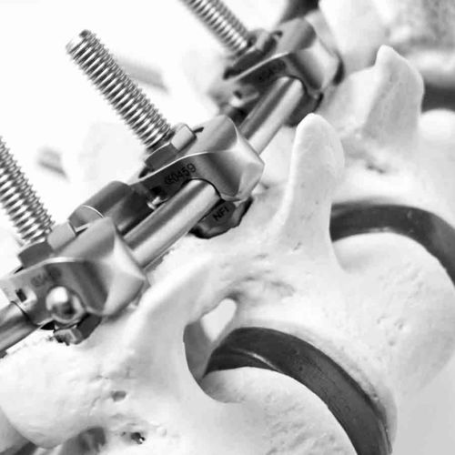 Thorako-lumbales Stabilisierungssystem für Osteosynthese - S.E.S+ - NEURO FRANCE Implants - dorsaler Zugang / für Erwachsene