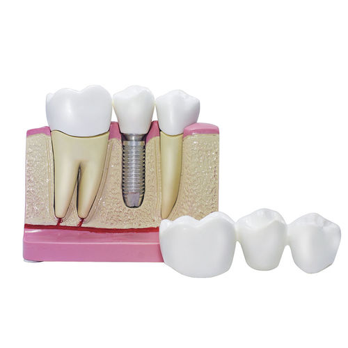 Anatomisches Modell / Dental - 8007  - Nacional Ossos - für Implantologie / für Zahnprothesen / Ausbildung