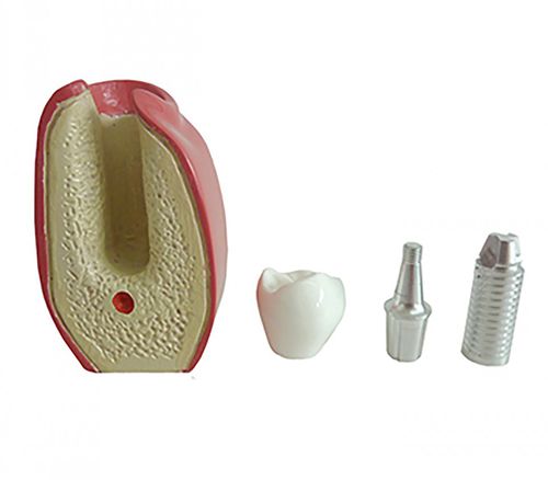 Anatomisches Modell / Dental - 9764  - Nacional Ossos - für Implantologie / für Zahnprothesen / für die Ausbildung