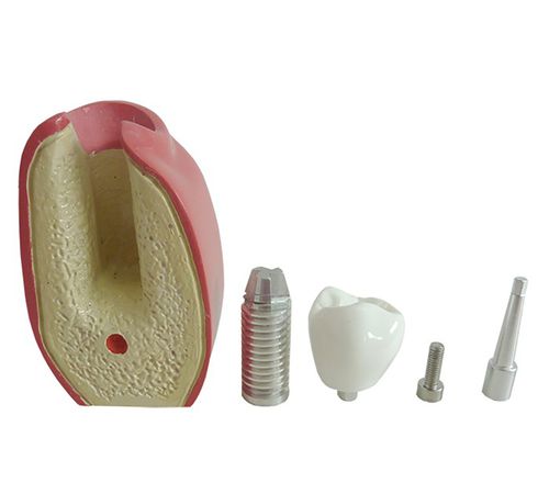 Anatomisches Modell / Dental - 9874  - Nacional Ossos - für Implantologie / für Zahnprothesen / für die Ausbildung