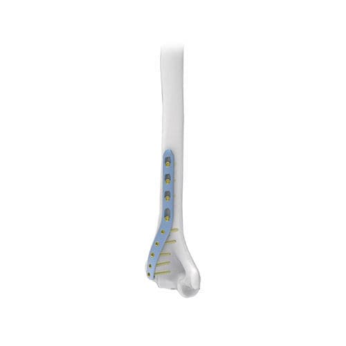 Kompressionsplatte für Humerus - NORMMED Medical Devices - distal / mit Verriegelung / Metall