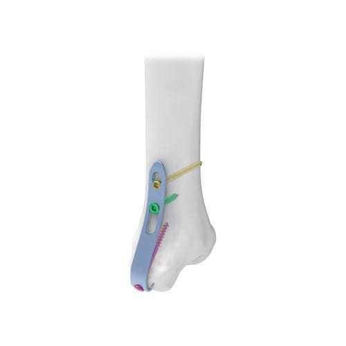 Kompressionsplatte für Malleolus - NORMMED Medical Devices - medial / mit Verriegelung / Metall
