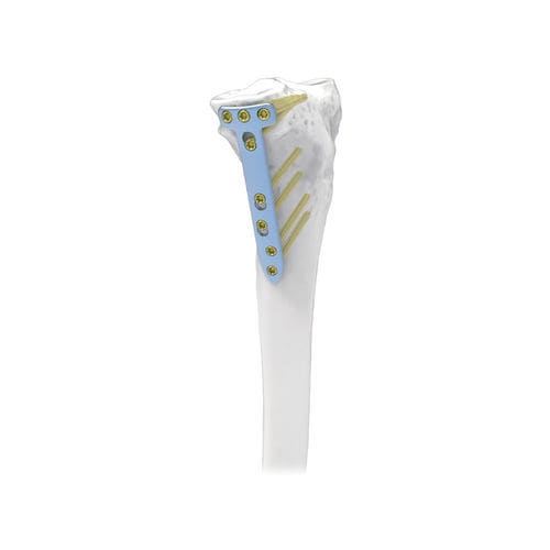 Osteotomieplatte für Tibia - NORMMED Medical Devices - mit Verriegelung / Metall