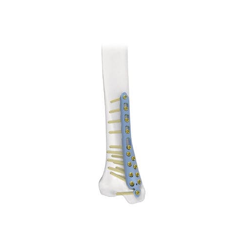 Kompressionsplatte für Tibia - PNM1014 - NORMMED Medical Devices - distal / medial / mit Verriegelung