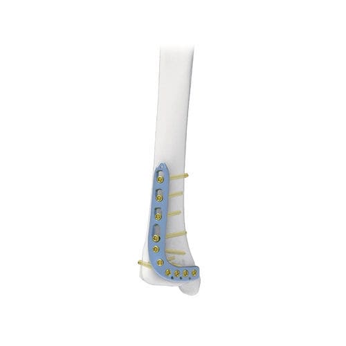 Kompressionsplatte für Tibia - PNM1015 - NORMMED Medical Devices - distal / anterolateral / mit Verriegelung