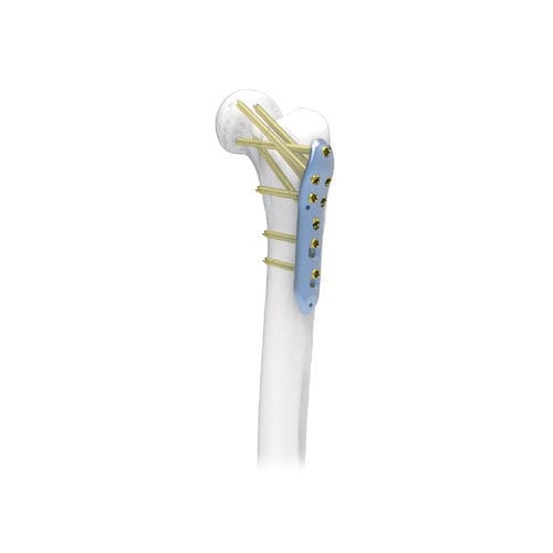 Kompressionsplatte für Oberschenkelknochen - NORMMED Medical Devices - proximal / mit Verriegelung / Metall