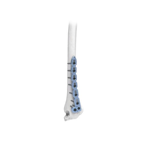 Kompressionsplatte für Radius - PNM1041 - NORMMED Medical Devices - distal / dorsal / mit Verriegelung
