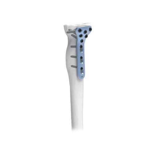 Kompressionsplatte für Radius - PNM1034 - NORMMED Medical Devices - proximal / mit Verriegelung / Metall