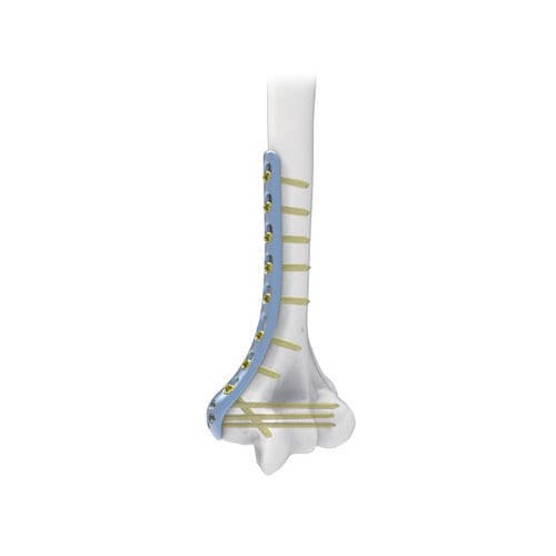 Kompressionsplatte für Humerus - PNM1005 - NORMMED Medical Devices - distal / medial / mit Verriegelung