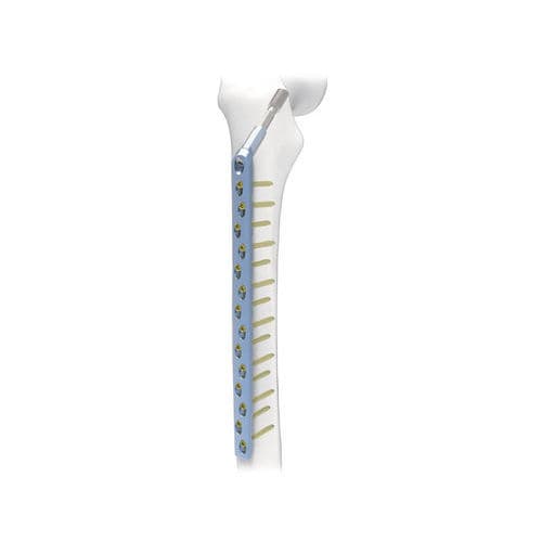 Kompressionsplatte für Oberschenkelknochen - PNM1024 - NORMMED Medical Devices - mit Verriegelung / Metall