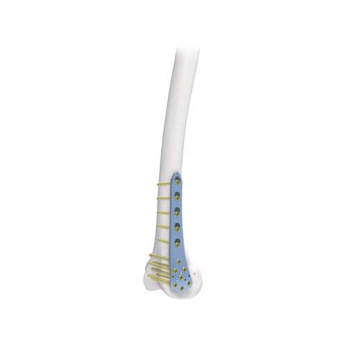 Kompressionsplatte für Oberschenkelknochen - PNM1022 - NORMMED Medical Devices - distal / mit Verriegelung / Metall