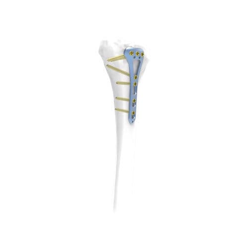 Kompressionsplatte für Tibia - NORMMED Medical Devices - distal / dorsolateral / mit Verriegelung