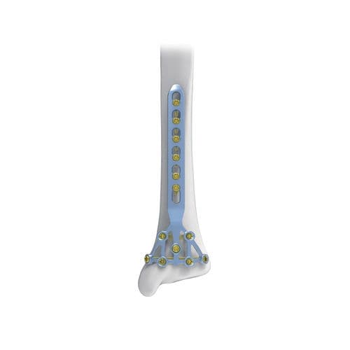 Kompressionsplatte für Tibia - Pilon - NORMMED Medical Devices - mit Verriegelung / Metall