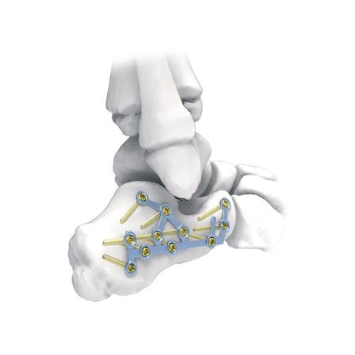 Kompressionsplatte für Calcaneum - PNM1032 - NORMMED Medical Devices - mit Verriegelung / Metall