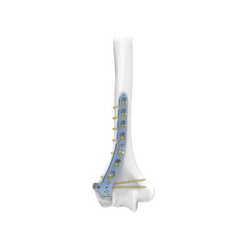 Kompressionsplatte für Humerus - PNM1007 - NORMMED Medical Devices - distal / dorsolateral / mit Verriegelung