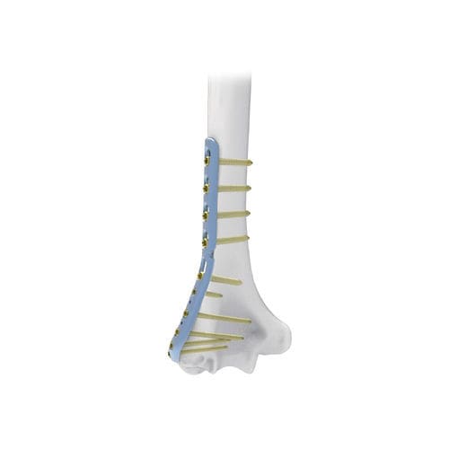 Kompressionsplatte für Humerus - NORMMED Medical Devices - distal / seitlich / mit Verriegelung