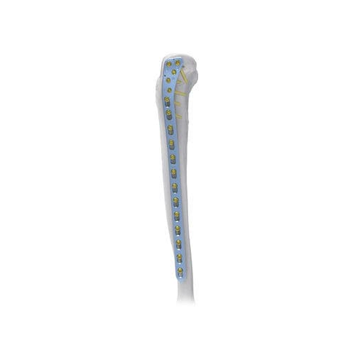 Kompressionsplatte für Tibia - Large  - NORMMED Medical Devices - proximal / seitlich / mit Verriegelung