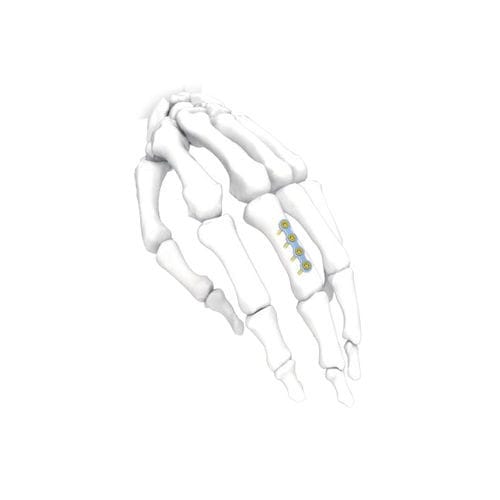 Kompressionsplatte für Hand - PNM5001 - NORMMED Medical Devices - mit Verriegelung / Metall