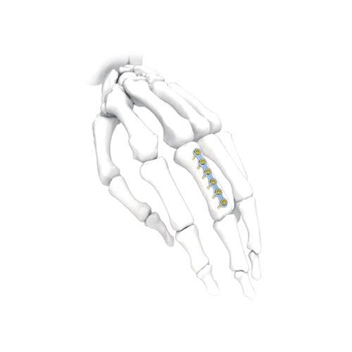 Kompressionsplatte für Hand - PNM5002 - NORMMED Medical Devices - mit Verriegelung / Metall