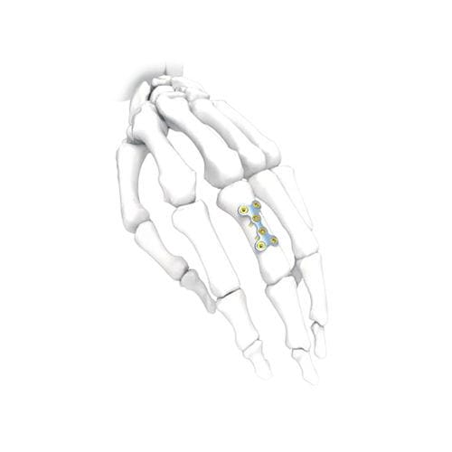 Kompressionsplatte für Hand - PNM5006-022 - NORMMED Medical Devices - mit Verriegelung / Metall