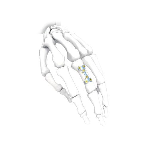 Kompressionsplatte für Hand - PNM5006-032 - NORMMED Medical Devices - mit Verriegelung / Metall