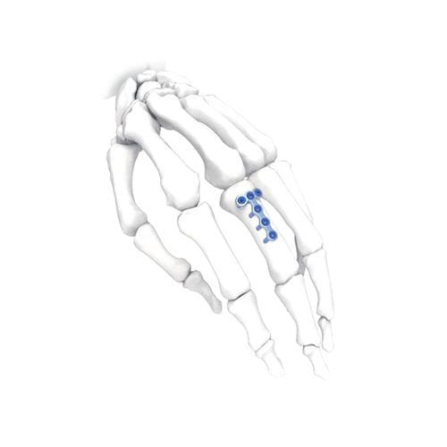 Kompressionsplatte für Hand - PNM5009 - NORMMED Medical Devices - mit Verriegelung / Metall