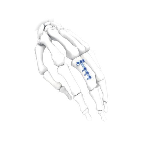 Kompressionsplatte für Hand - PNM5010 - NORMMED Medical Devices - mit Verriegelung / Metall