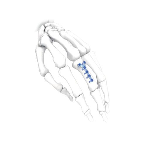 Kompressionsplatte für Hand - Y  - NORMMED Medical Devices - mit Verriegelung / Metall