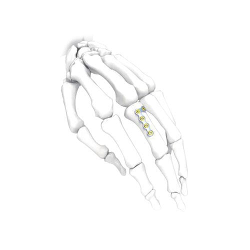 Kompressionsplatte für Hand - NORMMED Medical Devices - mit Verriegelung / Metall