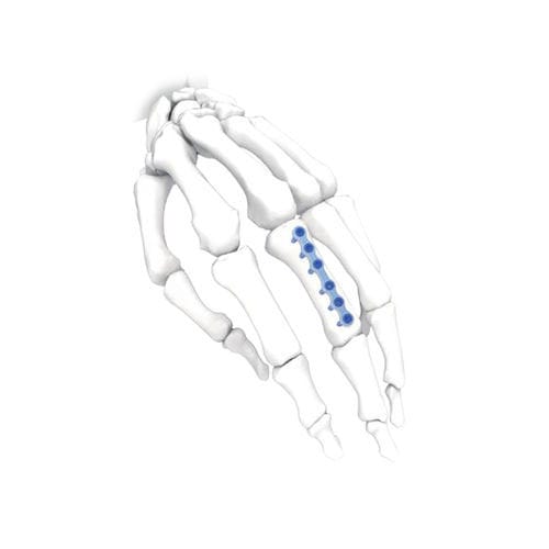 Kompressionsplatte für Hand - Long - NORMMED Medical Devices - für Fuß / mit Verriegelung / Metall
