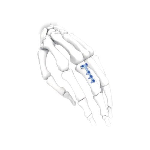 Kompressionsplatte für Hand - T - NORMMED Medical Devices - für Fuß / mit Verriegelung / Metall