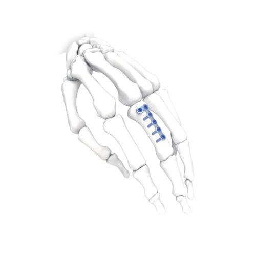 Kompressionsplatte für Hand - L - NORMMED Medical Devices - für Fuß / mit Verriegelung / Metall