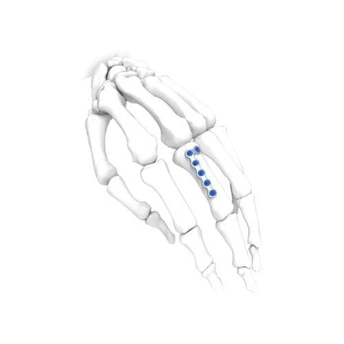Kompressionsplatte für Hand - PNM5012-100 - NORMMED Medical Devices - für Fuß / mit Verriegelung / Metall
