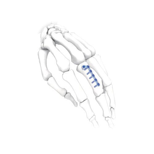 Kompressionsplatte für Hand - L Oblique  - NORMMED Medical Devices - für Fuß / mit Verriegelung / Metall