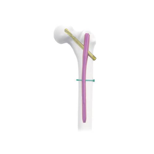 Marknagel für Oberschenkelknochen - NORMMED Medical Devices - für Trochanter / Metall