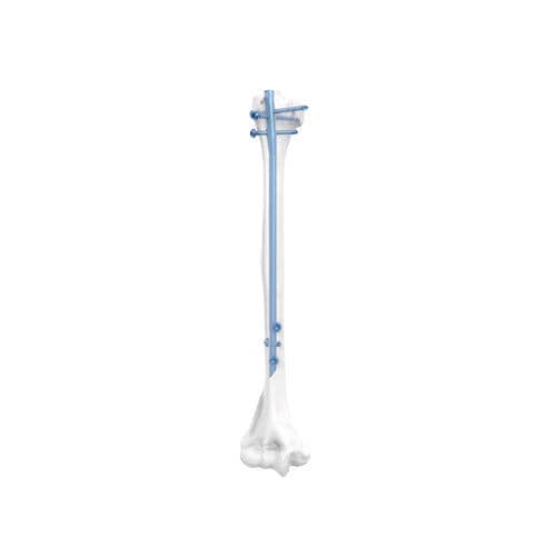 Marknagel / Humerus - NORMMED Medical Devices - mit diaphysärer Fixierung / mit proximaler Fixierung / Metall