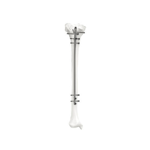 Marknagel / für Schienbein - PNM3308 - NORMMED Medical Devices - mit diaphysärer Fixierung / mit proximaler Fixierung / Metall