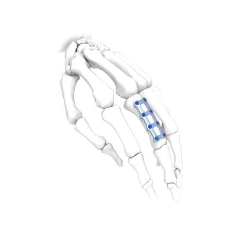 Kompressionsplatte für Hand - Mini  - NORMMED Medical Devices - mit Verriegelung / Metall