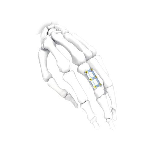 Kompressionsplatte für Hand - H Short - NORMMED Medical Devices - für Fuß / mit Verriegelung / Metall