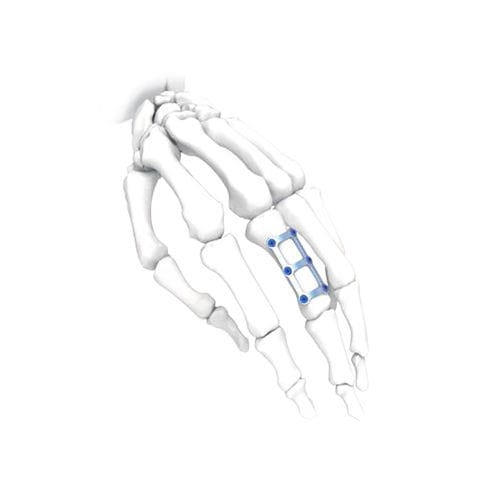 Kompressionsplatte für Hand - H Long - NORMMED Medical Devices - für Fuß / mit Verriegelung / Metall