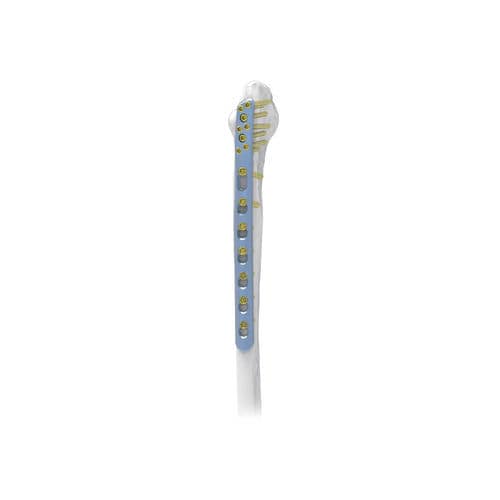 Kompressionsplatte für Fibula - PNM1017 - NORMMED Medical Devices - distal / dorsolateral / mit Verriegelung