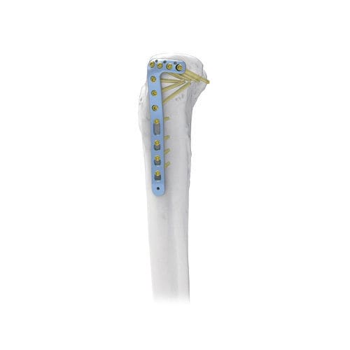 Kompressionsplatte für Tibia - NORMMED Medical Devices - proximal / seitlich / mit Verriegelung