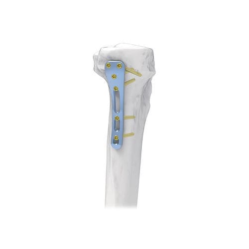 Kompressionsplatte für Tibia - NORMMED Medical Devices - proximal / posteromedial / mit Verriegelung