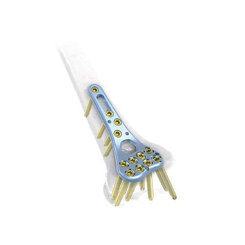 Kompressionsplatte für Radius - NORMMED Medical Devices - distal / mit Verriegelung / Metall