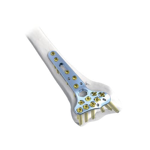Kompressionsplatte für Radius - Rim  - NORMMED Medical Devices - distal / mit Verriegelung / Metall