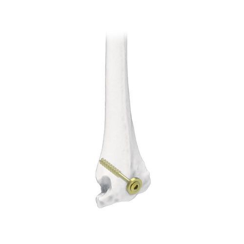 Knochen-Kompressionsschraube / für Humerus - NORMMED Medical Devices - kanüliert / Metall