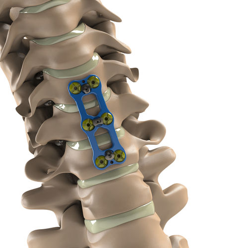HWS-Arthrodeseplatte - Tİ-6Al-4V ELI  - Aditus Medical - mit Verriegelung / Metall / 2 Ebenen